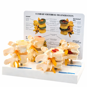 Lumbar Vertebrae Degeneration Model – Spine Anatomy Educational Model